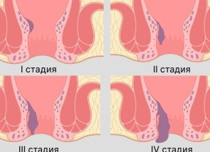 Как узнать есть геморрой или нет?