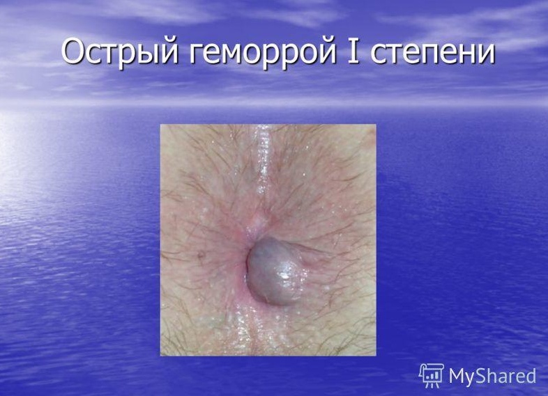 Симптомы и лечение острого геморроя