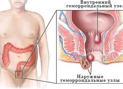 Признаки геморроя