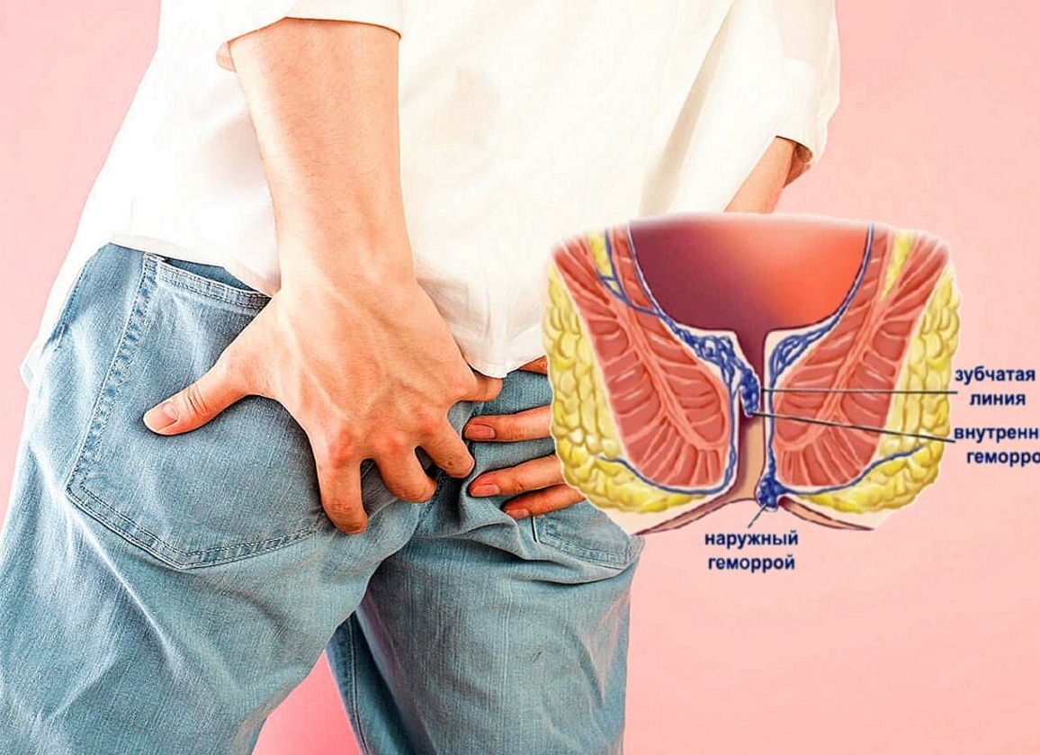 Бывает ли геморрой от нервов?