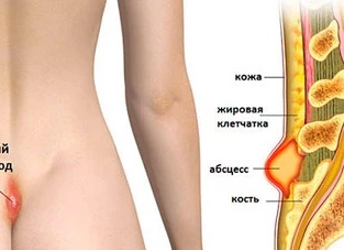 Копчиковый свищ