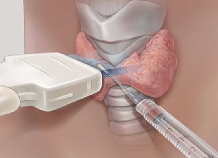 Прокалывание геморроя иглой в домашних условиях — плохая идея, осложняющая лечение