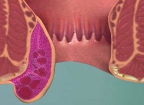 Лечение тромбированного геморроя