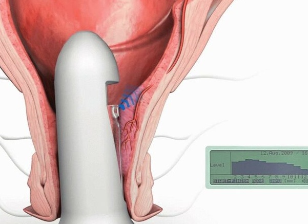 Лечение геморроя методом HAL RAR