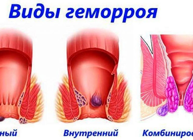 Проходит ли геморрой сам по себе?