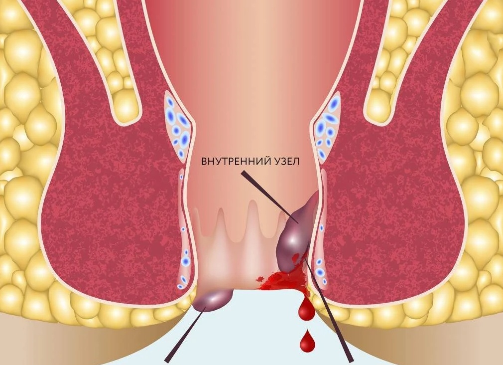 Выделение слизи при геморрое