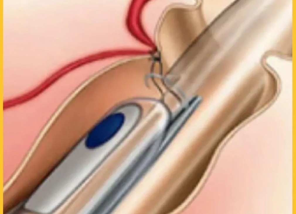 Удаление геморроя ультразвуком