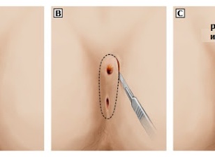 Эпителиальная киста копчика