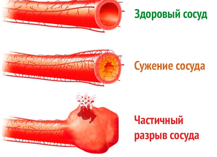 Геморрой и сосуды