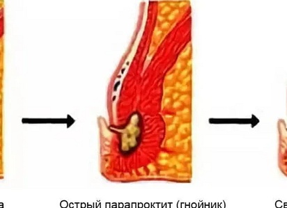 Как отличить свищ от геморроя?