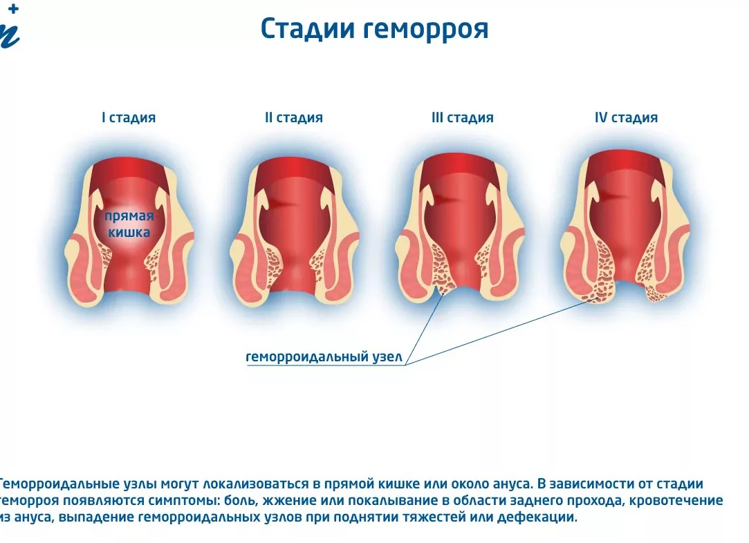 Запущенная форма геморроя