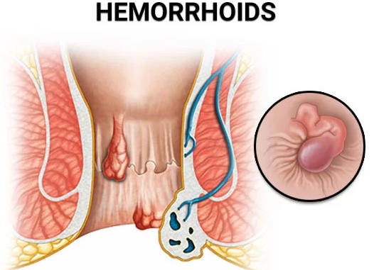 Геморрой не кровоточит