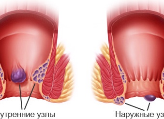 Внутренний и внешний геморрой