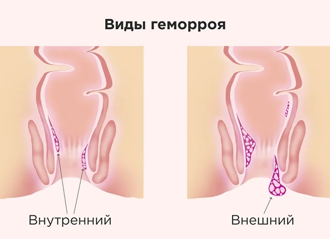 Лечение геморроя при беременности