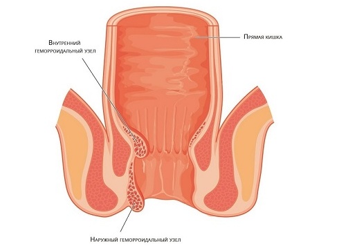 Опасен ли геморрой