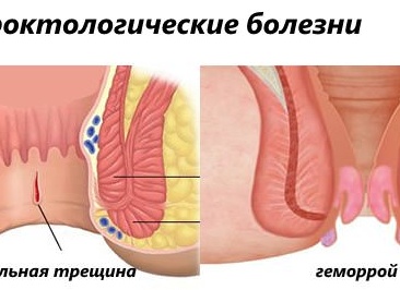 Чем отличается выпадение прямой кишки от геморроя?
