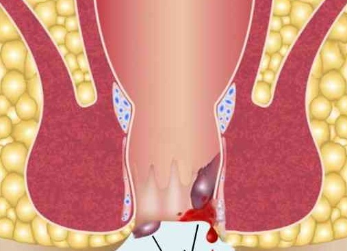 Во сколько лет может появиться геморрой?