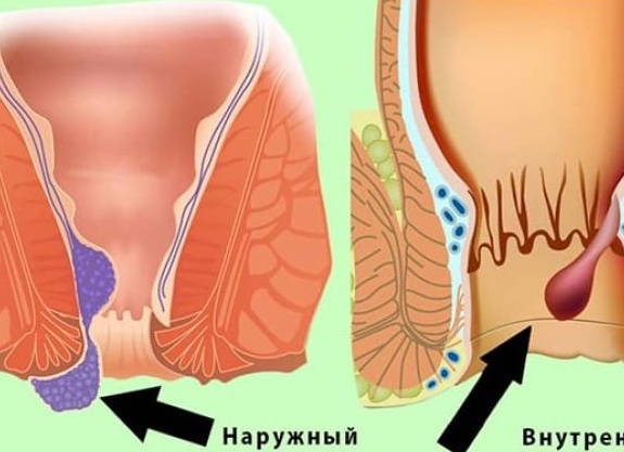 Как вправить геморроидальный узел?