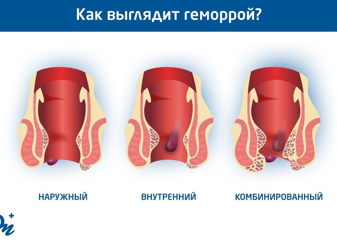 Может ли геморрой давать температуру?