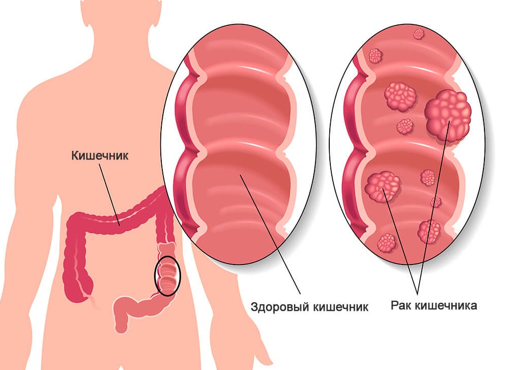 Какой онкомаркер показывает рак прямой кишки?