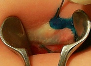 Парапроктит у детей