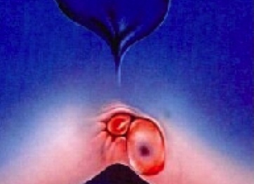 Фурункул около заднего прохода