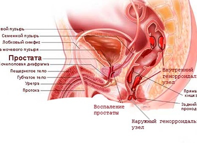 Геморрой и половая жизнь