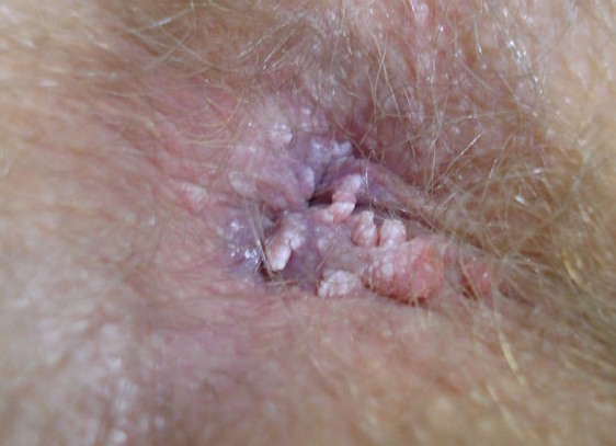 Кондиломы на анусе Кондиломы на анусе