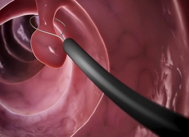 Симптомы и лечение внутреннего геморроя