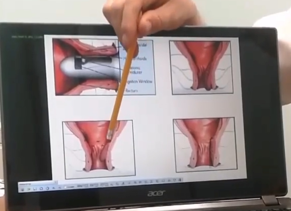 Метод Лонго при геморрое