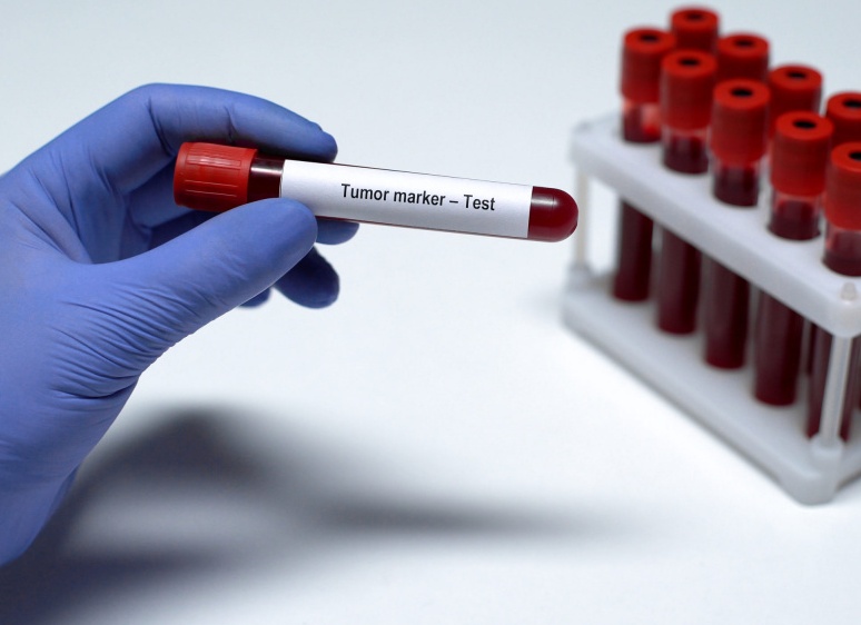 Какие анализы крови делают при раке прямой кишки? Какие анализы крови делают при раке прямой кишки?