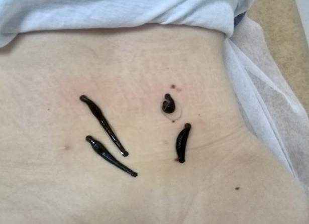 Пиявки при геморрое