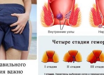 Геморрой от анального секса