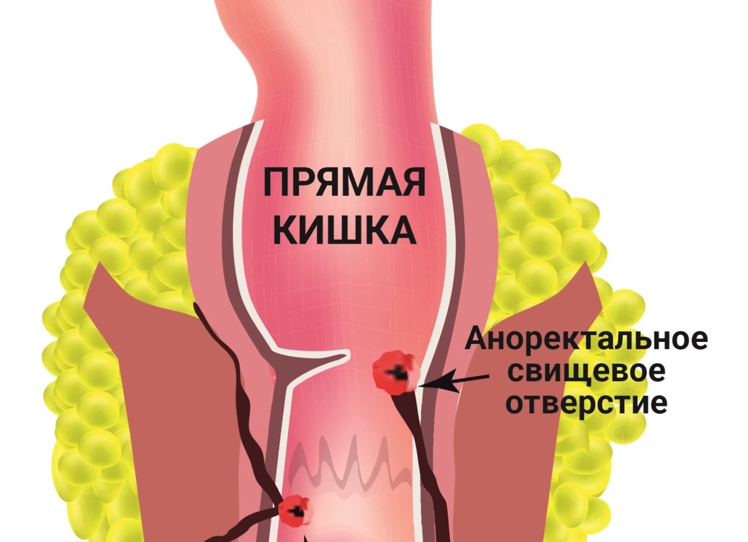 Операция по удалению свища прямой кишки