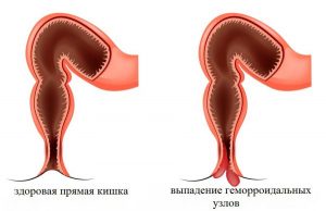 Выпадение геморроя